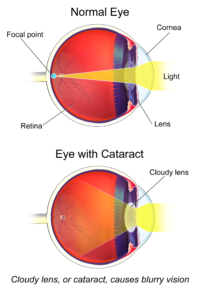 What Causes Cloudy Vision in One Eye?